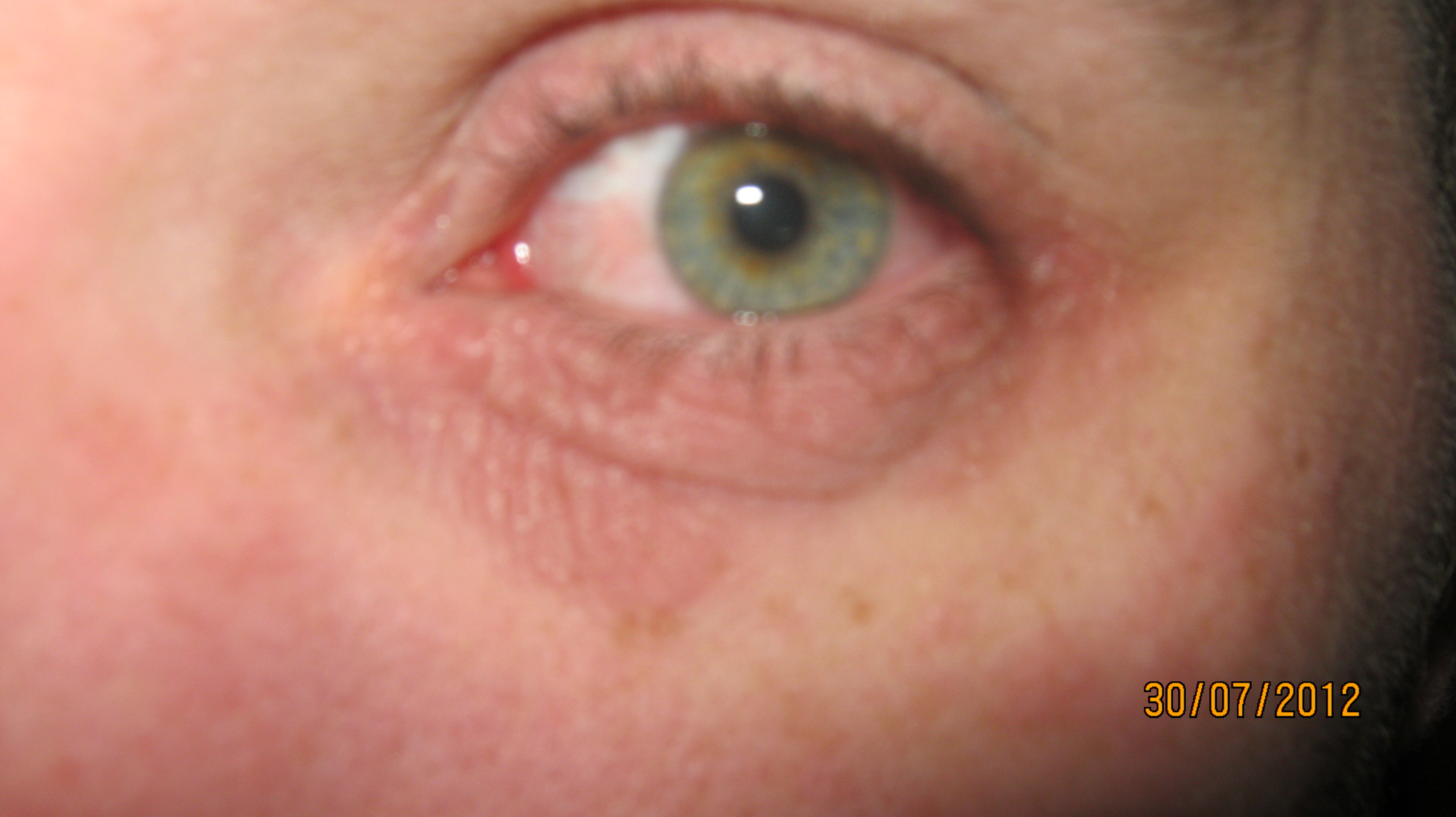 Yeux En Feu Help J Ai Trop Mal Allergies Et Eczema Forum Sante Doctissimo Yeux En Feu Help J Ai Trop Mal Allergies Et Eczema Forum Sante Doctissimo