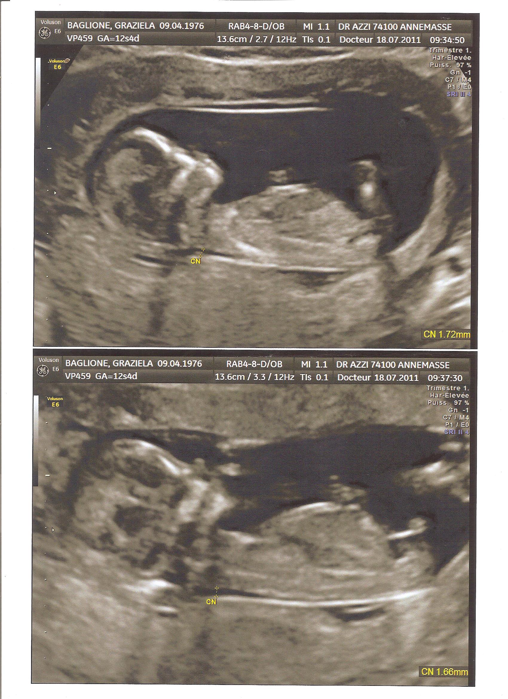 Echo 12 Semaines Et 4 Jours Vos Avis Svp Echographie Connaitre Le Sexe De Votre Bebe Forum Grossesse Amp Bebe Doctissimo