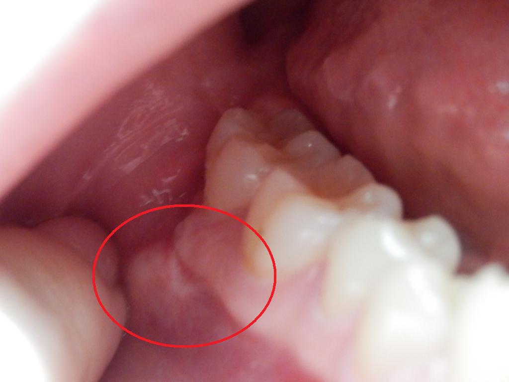 Rage De Dents Gencive Gonflee Depuis 4 Mois Help Problemes Dentaires Forum Sante Doctissimo Rage De Dents Gencive Gonflee Depuis 4 Mois Help Problemes Dentaires Forum Sante Doctissimo