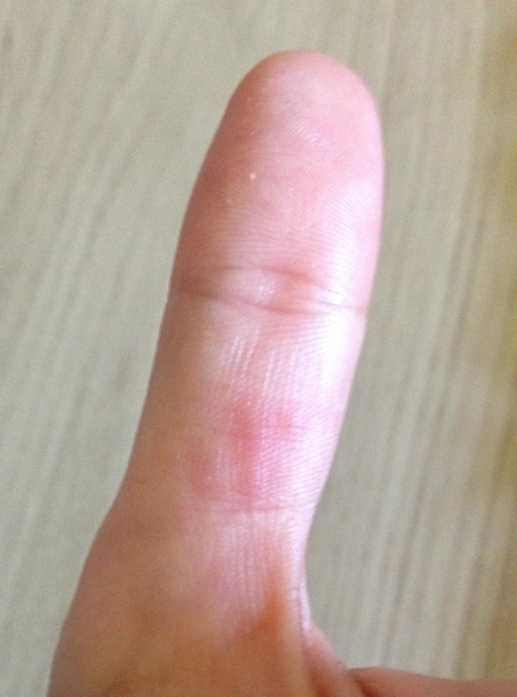 Boutons rouges aux doigts (photo) - Allergies et eczéma - FORUM Santé ...