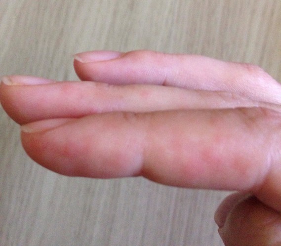Boutons rouges aux doigts (photo) - Allergies et eczéma - FORUM Santé ...