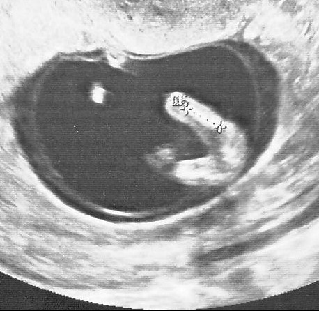 Echo Des 13sa Alors Zizi Ou Zezette Lol 1 Nouvelle Photo Echographie Connaitre Le Sexe De Votre Bebe Forum Grossesse Amp Bebe Doctissimo Echo Des 13sa Alors Zizi Ou Zezette Lol 1 Nouvelle Photo Echographie Connaitre Le Sexe De Votre Bebe Forum Grossesse Amp Bebe Doctissimo