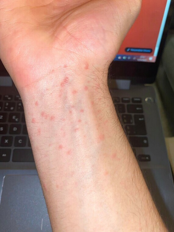 Boutons rouges mains et pieds - Eczéma - Acné, psoriasis et problèmes ...