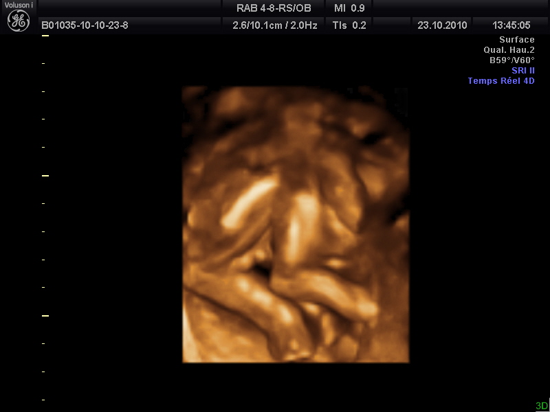 Boule Bourse Echographie 15sa 4 Jours Echographie Connaitre Le Sexe De Votre Bebe Forum Grossesse Amp Bebe Doctissimo Boule Bourse Echographie 15sa 4 Jours Echographie Connaitre Le Sexe De Votre Bebe Forum Grossesse Amp Bebe Doctissimo