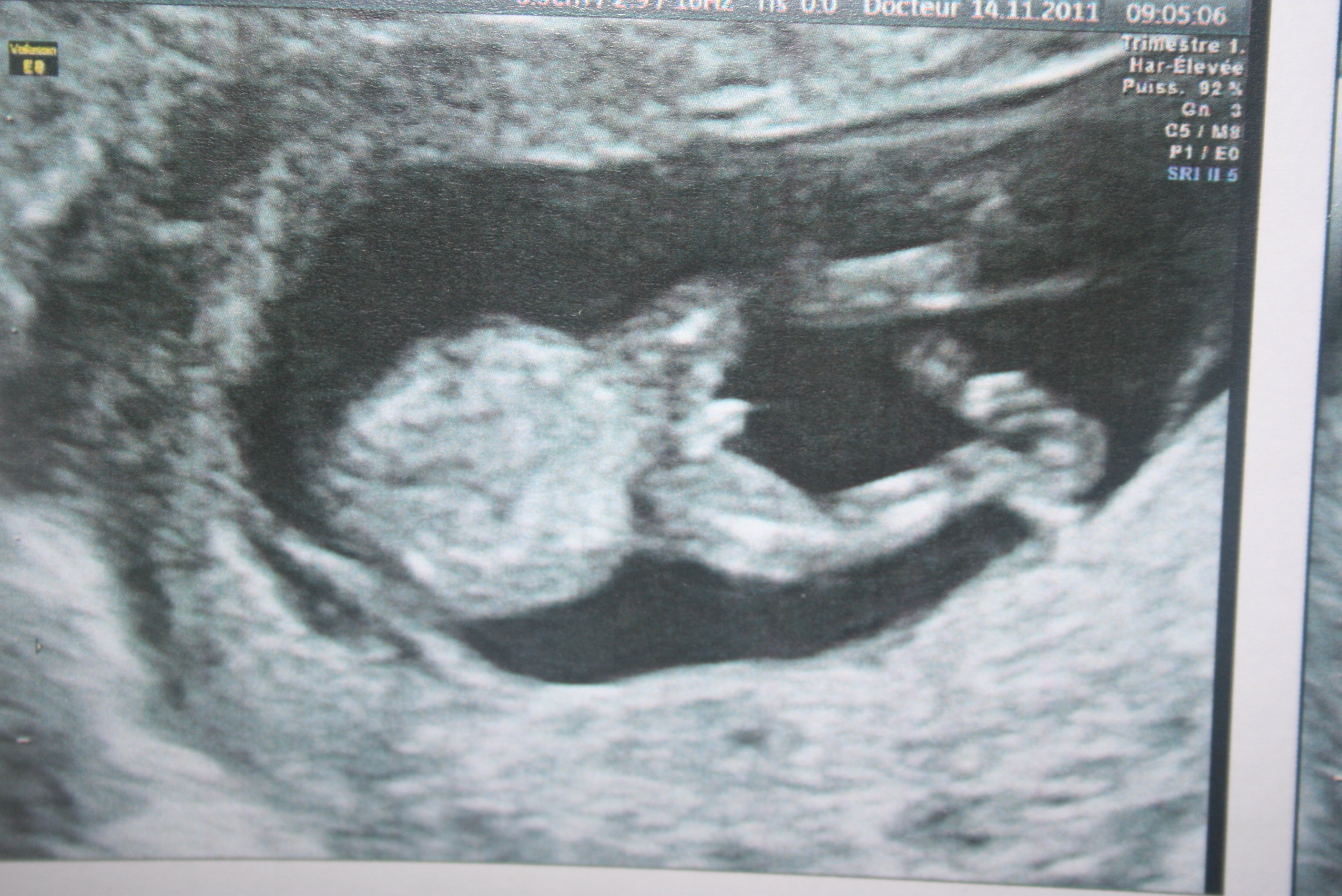 Boule Bourse Echographie 15sa 4 Jours Echographie Connaitre Le Sexe De Votre Bebe Forum Grossesse Amp Bebe Doctissimo Boule Bourse Echographie 15sa 4 Jours Echographie Connaitre Le Sexe De Votre Bebe Forum Grossesse Amp Bebe Doctissimo