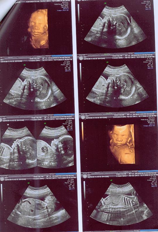 Echo 23 Sa A Quoi Pensez Vous Echographie Connaitre Le Sexe De Votre Bebe Forum Grossesse Amp Bebe Doctissimo Echo 23 Sa A Quoi Pensez Vous Echographie Connaitre Le Sexe De Votre Bebe Forum Grossesse Amp Bebe Doctissimo