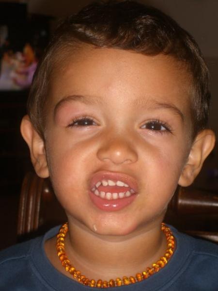Piqure Qui A Enfle Quoi Faire Developpement De L Enfant Forum Grossesse Amp Bebe Doctissimo Piqure Qui A Enfle Quoi Faire Developpement De L Enfant Forum Grossesse Amp Bebe Doctissimo