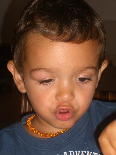 Piqure Qui A Enfle Quoi Faire Developpement De L Enfant Forum Grossesse Amp Bebe Doctissimo Piqure Qui A Enfle Quoi Faire Developpement De L Enfant Forum Grossesse Amp Bebe Doctissimo