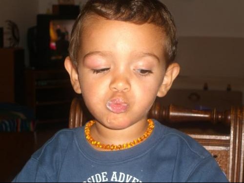 Piqure Qui A Enfle Quoi Faire Developpement De L Enfant Forum Grossesse Amp Bebe Doctissimo
