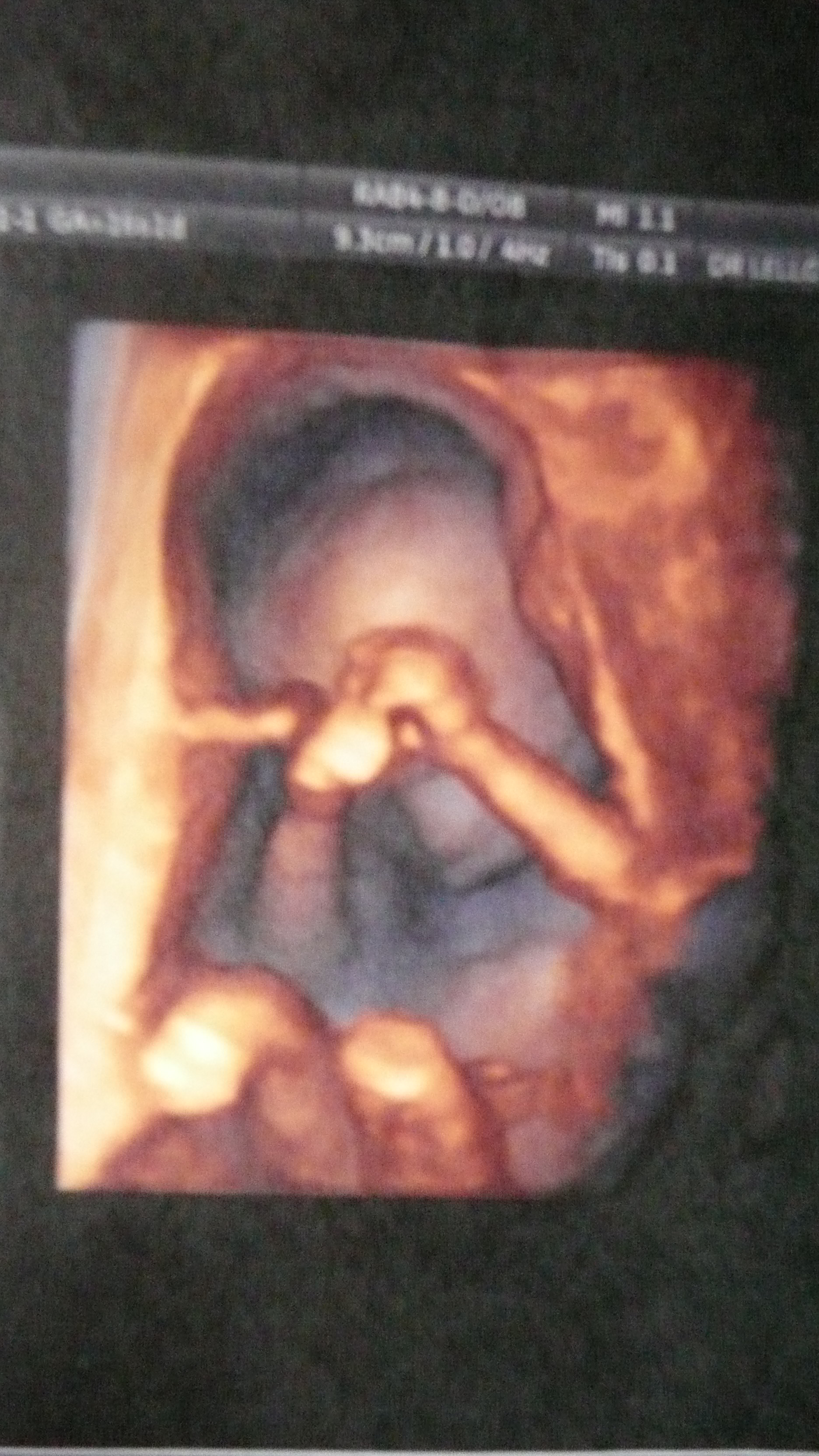 Postez Svp Une Echo De Bebe A 16 Sa Fille Ou Garcon Echographie Connaitre Le Sexe De Votre Bebe Forum Grossesse Amp Bebe Doctissimo