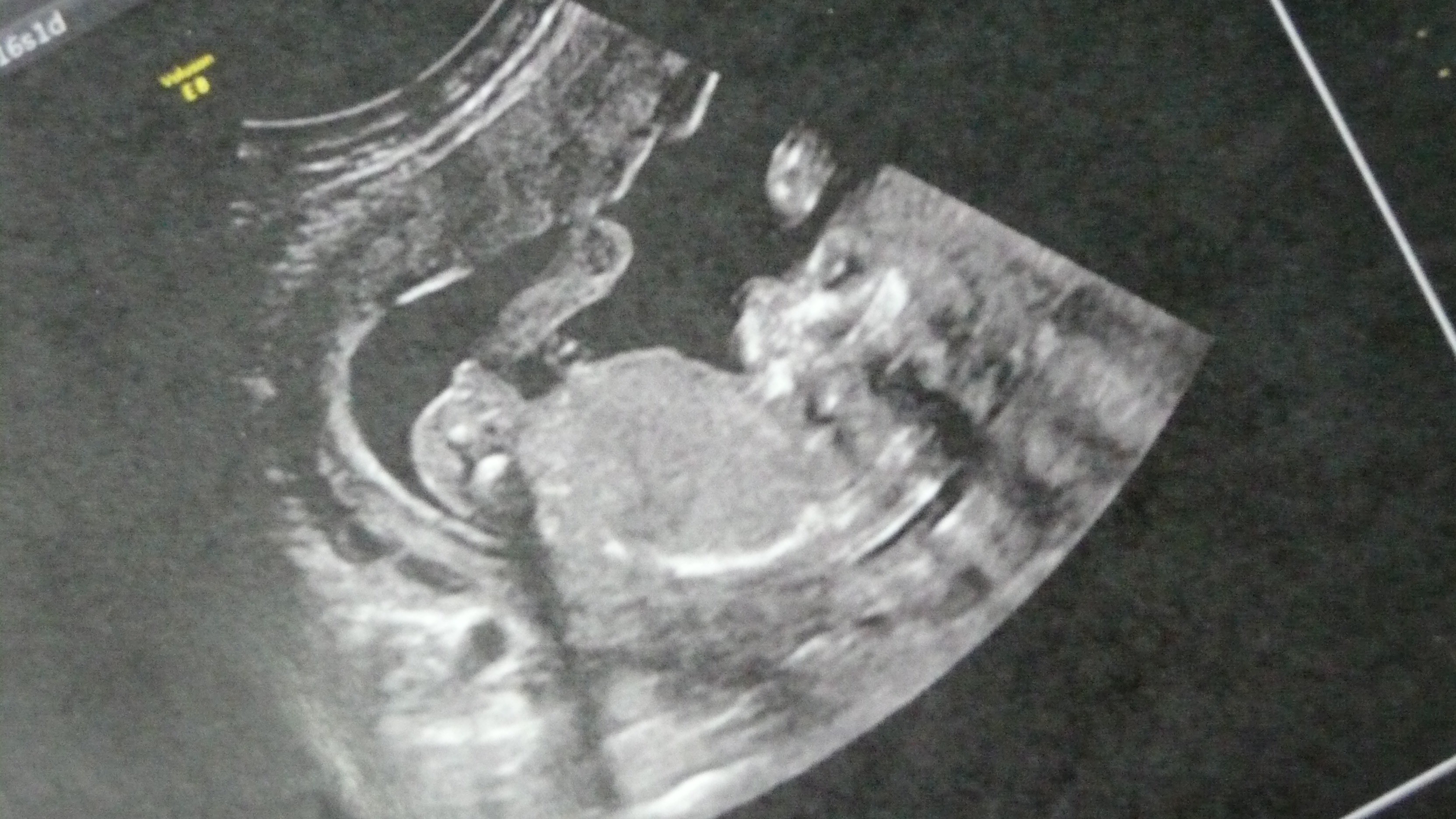 Postez Svp Une Echo De Bebe A 16 Sa Fille Ou Garcon Echographie Connaitre Le Sexe De Votre Bebe Forum Grossesse Amp Bebe Doctissimo