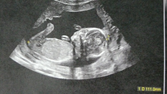 Postez Svp Une Echo De Bebe A 16 Sa Fille Ou Garcon Postez Svp Une Echo De Bebe A 16 Sa Fille Ou Garcon