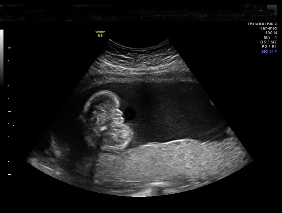 Votre Avis Fille Ou Garcon Echographie Connaitre Le Sexe De Votre Bebe Forum Grossesse Amp Bebe Doctissimo Votre Avis Fille Ou Garcon Echographie Connaitre Le Sexe De Votre Bebe Forum Grossesse Amp Bebe Doctissimo