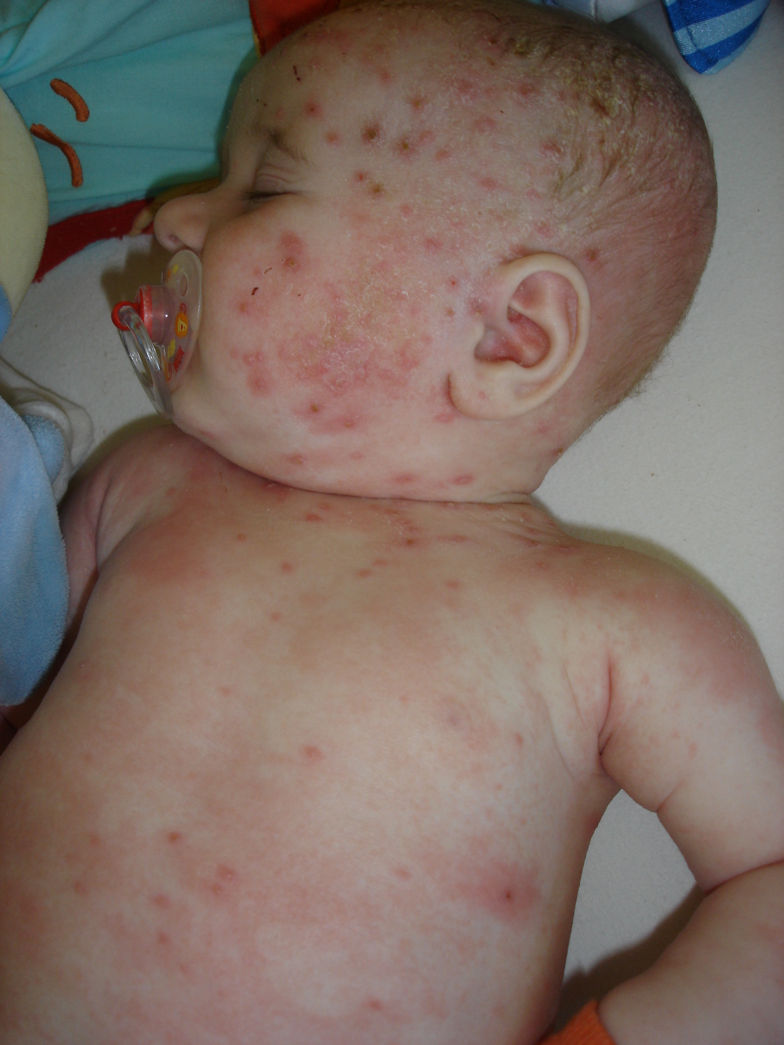 Varicelle Ou Pas Bebe Grandit Forum Grossesse Amp Bebe Doctissimo Varicelle Ou Pas Bebe Grandit Forum Grossesse Amp Bebe Doctissimo