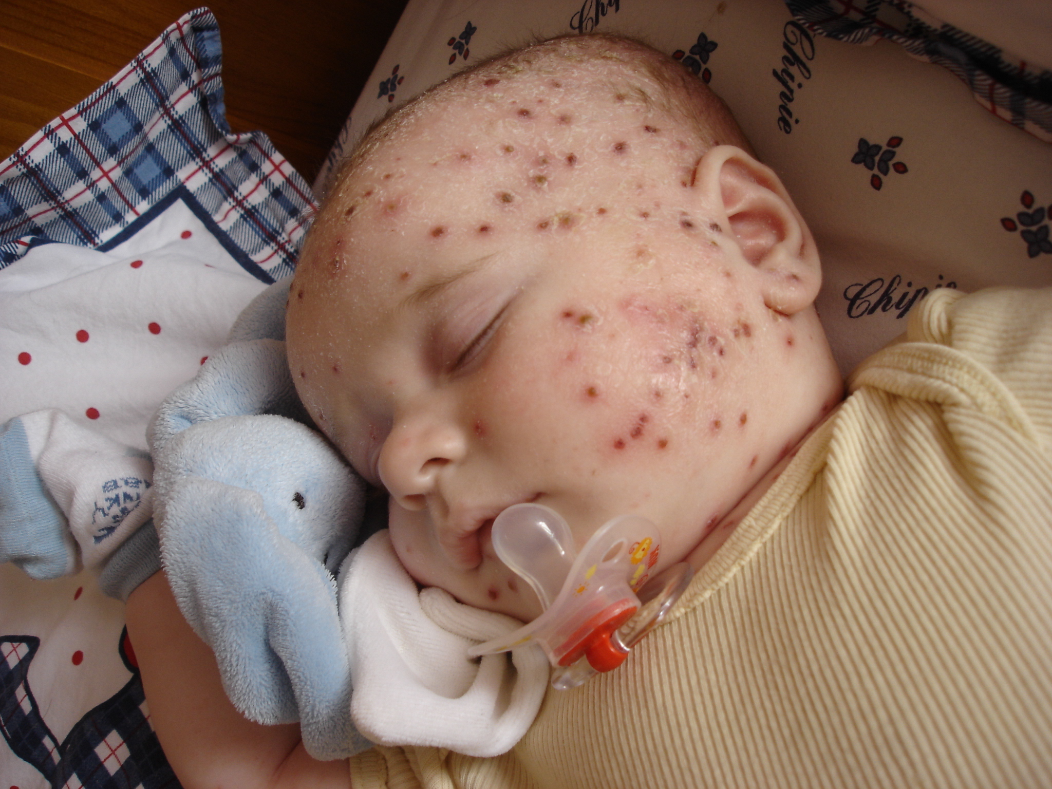 Help Varicelle Bebe Grandit Forum Grossesse Amp Bebe Doctissimo Help Varicelle Bebe Grandit Forum Grossesse Amp Bebe Doctissimo