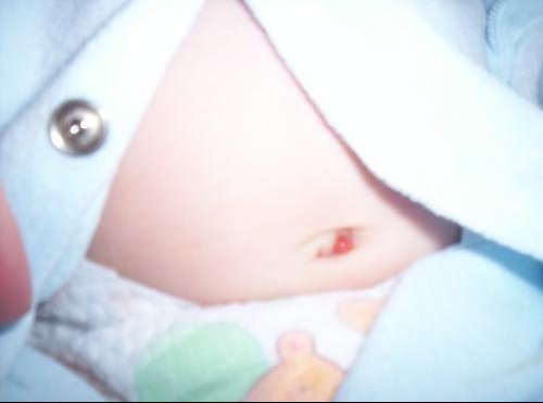 Cicatrice Nombril Consulter Ou Non Photo Mamans Et Futures Mamans Du Quebec Forum Grossesse Amp Bebe Doctissimo Cicatrice Nombril Consulter Ou Non Photo Mamans Et Futures Mamans Du Quebec Forum Grossesse Amp Bebe Doctissimo