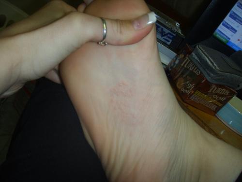 Boutons En Dessous Des Pieds Es Ce Normal Forum Libre Sante Forum Sante Doctissimo Boutons En Dessous Des Pieds Es Ce Normal Forum Libre Sante Forum Sante Doctissimo