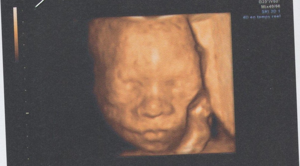 Le Meilleur Moment Pour Echo 3d Echographie Connaitre Le Sexe De Votre Bebe Forum Grossesse Amp Bebe Doctissimo