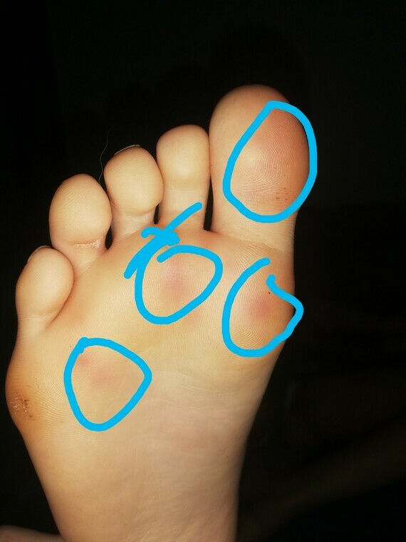 Plaque sous le pied Acné, psoriasis et problèmes de peau FORUM Santé Doctissimo