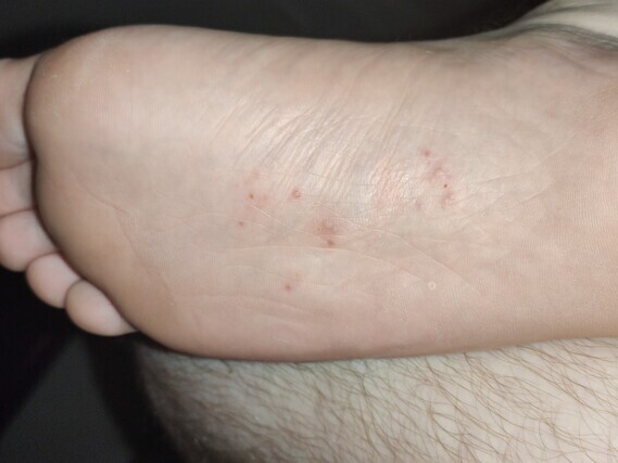 Boutons sous les pieds et liquide ? - Eczéma - Acné, psoriasis et ...