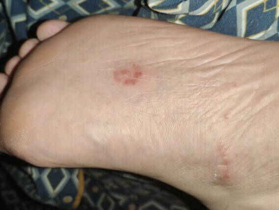 Boutons sous les pieds et liquide ? - Eczéma - Acné, psoriasis et ...