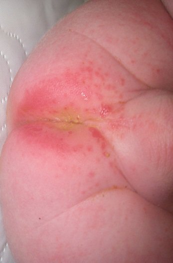 L Erytheme Fessier Mamans Et Futures Mamans Du Quebec Forum Grossesse Amp Bebe Doctissimo L Erytheme Fessier Mamans Et Futures Mamans Du Quebec Forum Grossesse Amp Bebe Doctissimo