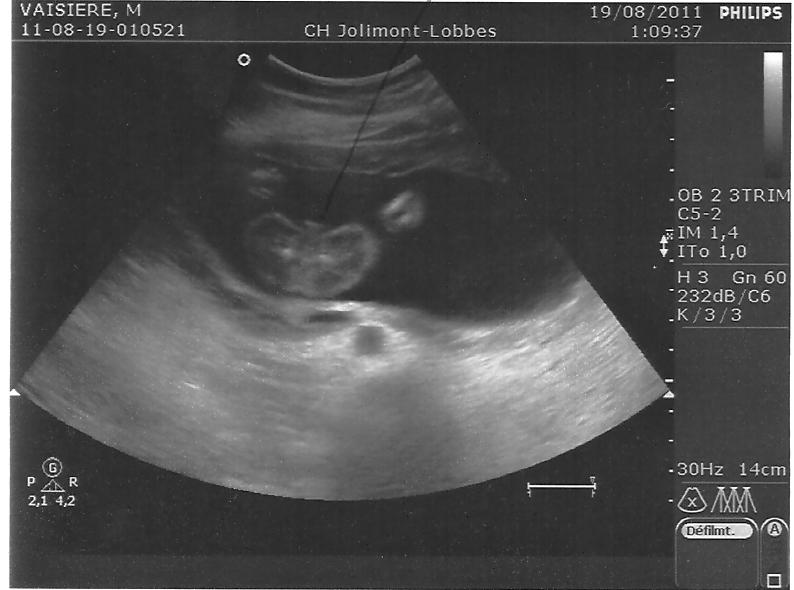 Echographie A 22sg Helppp Echographie Connaitre Le Sexe De Votre Bebe Forum Grossesse Amp Bebe Doctissimo Echographie A 22sg Helppp Echographie Connaitre Le Sexe De Votre Bebe Forum Grossesse Amp Bebe Doctissimo