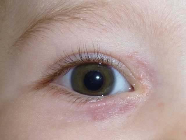 Point Rouge Autour Des Yeux Bebe