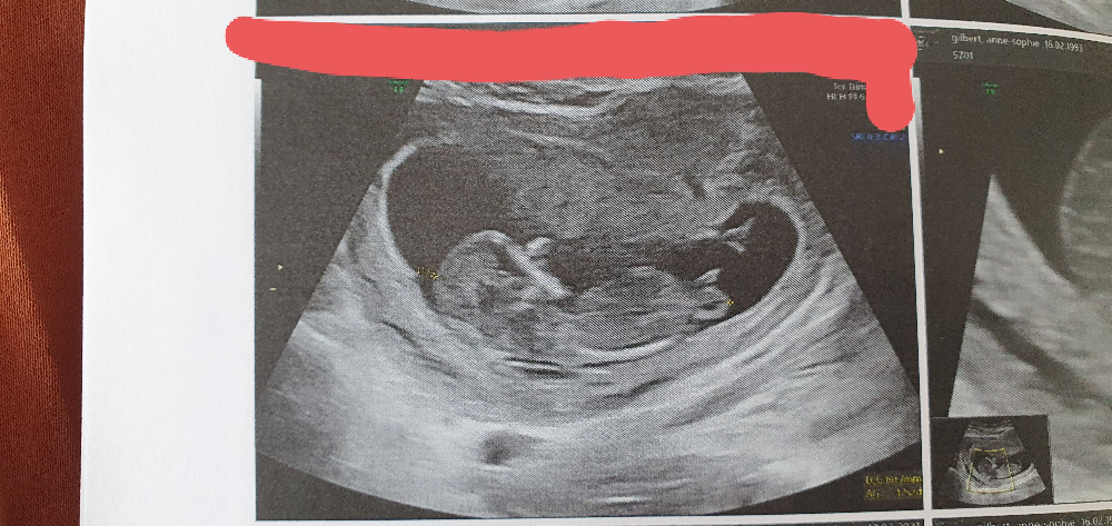 4 Photos De Bourgeons Mais Je N Arrive Pas A Savoir Echographie Connaitre Le Sexe De Votre Bebe Forum Grossesse Amp Bebe Doctissimo