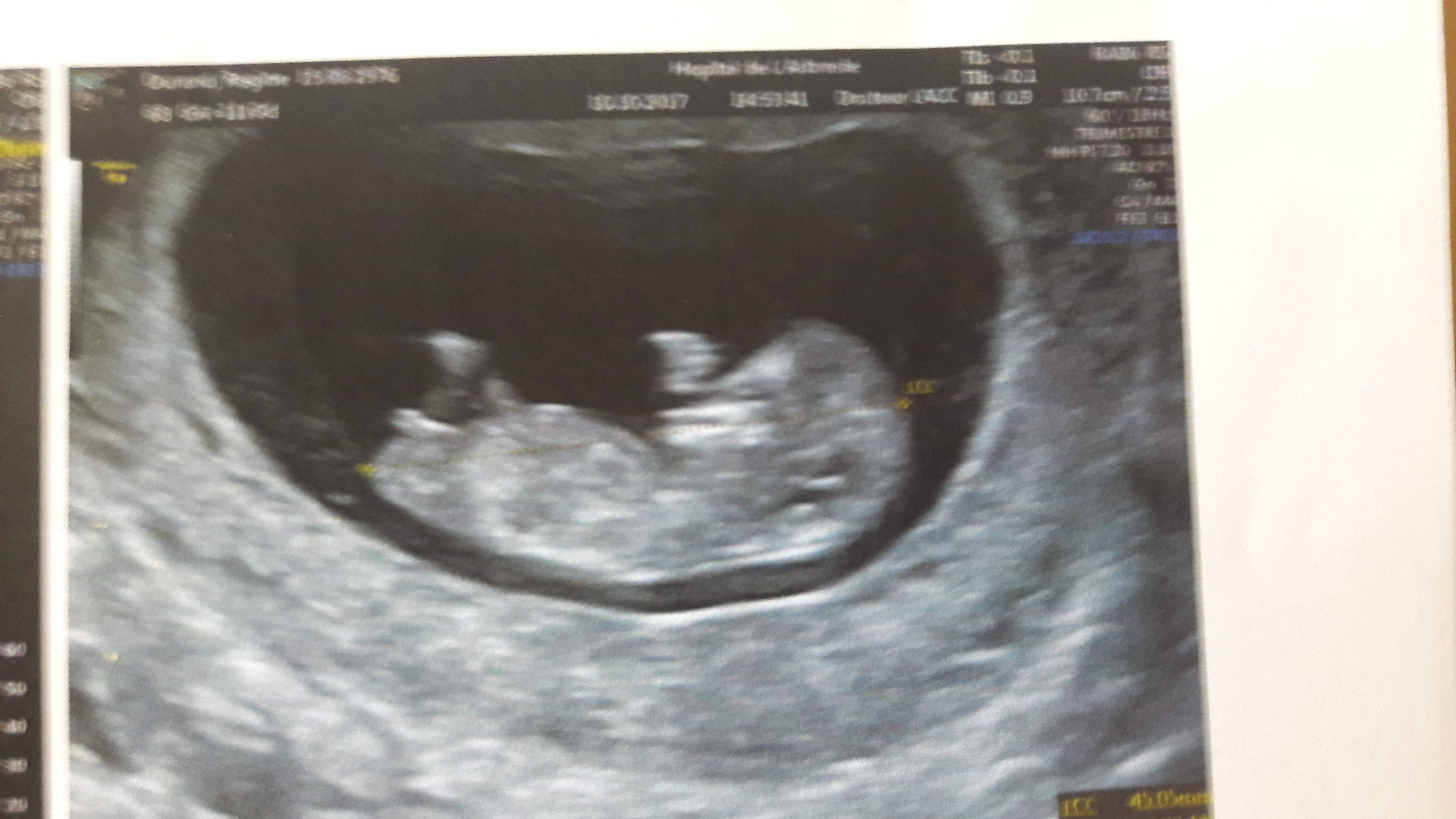 Mon 6eme Bebe A 11 Sa Fille Ou Garcon Echographie Connaitre Le Sexe De Votre Bebe Forum Grossesse Amp Bebe Doctissimo Mon 6eme Bebe A 11 Sa Fille Ou Garcon Echographie Connaitre Le Sexe De Votre Bebe Forum Grossesse Amp Bebe Doctissimo