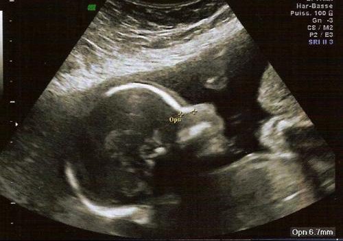 Echo Morpho Au Secours On Dirait Un Singe Echographie Connaitre Le Sexe De Votre Bebe Forum Grossesse Amp Bebe Doctissimo Echo Morpho Au Secours On Dirait Un Singe Echographie Connaitre Le Sexe De Votre Bebe Forum Grossesse Amp Bebe Doctissimo