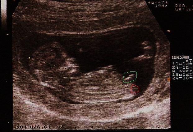 Help Svp Est Ce Le Tubercule Genital Echographie Connaitre Le Sexe De Votre Bebe Forum Grossesse Amp Bebe Doctissimo Help Svp Est Ce Le Tubercule Genital Echographie Connaitre Le Sexe De Votre Bebe Forum Grossesse Amp Bebe Doctissimo