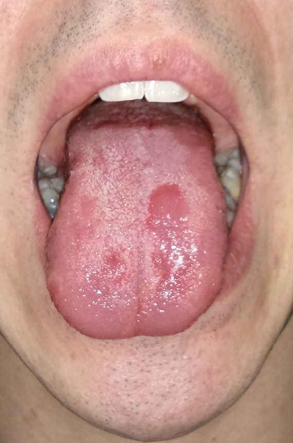 Mycose Ou Papilles Filiformes Mycose Ou Papilles Filiformes