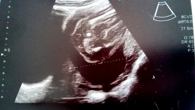 Echo 22 Sa Avis Sexe Bebe Echographie Connaitre Le Sexe De Votre Bebe Forum Grossesse Amp Bebe Doctissimo Echo 22 Sa Avis Sexe Bebe Echographie Connaitre Le Sexe De Votre Bebe Forum Grossesse Amp Bebe Doctissimo