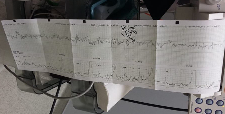 Monitoring Contractions Grossesse Forum Grossesse Amp Bebe Doctissimo