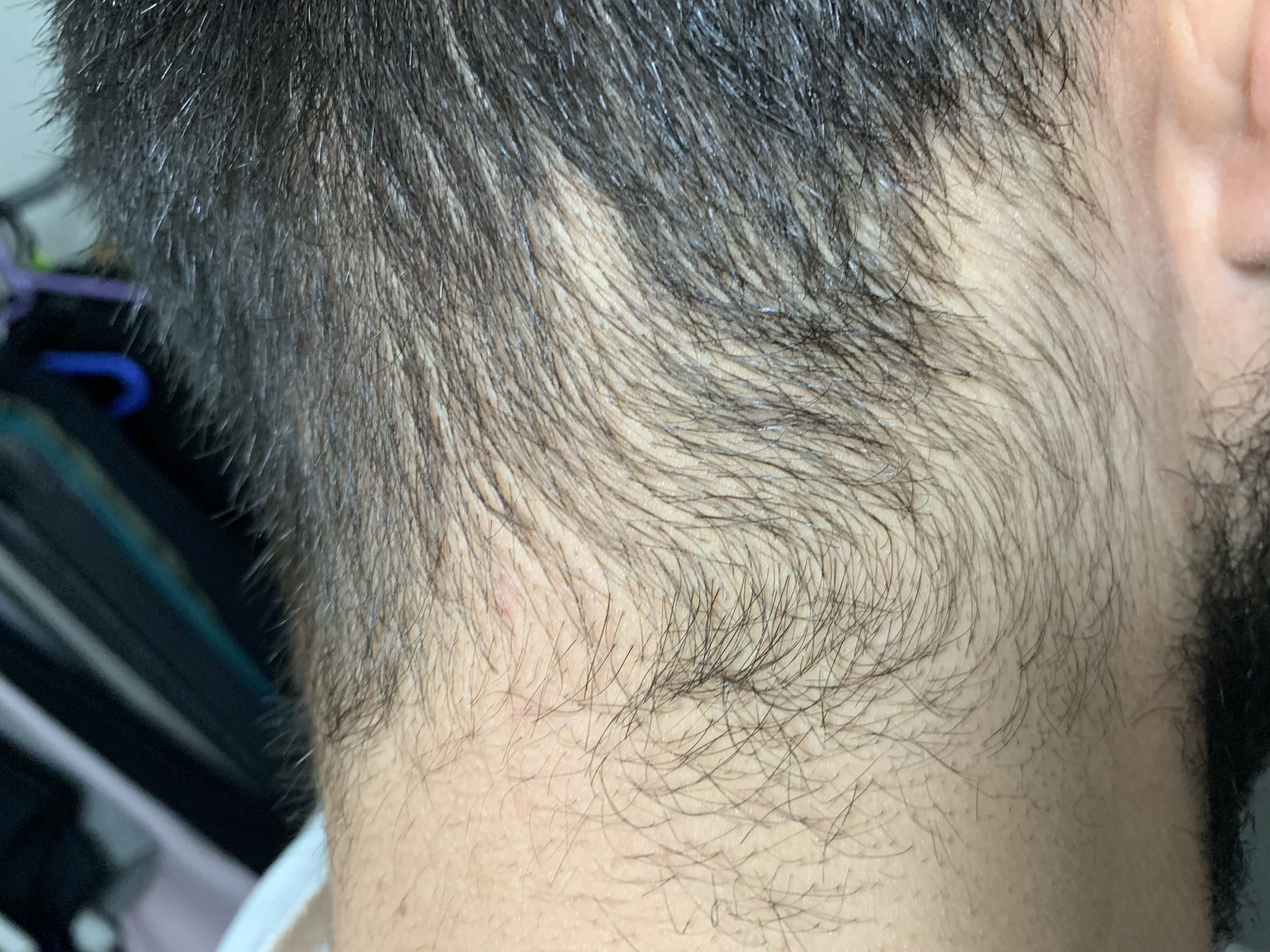 Incroyable Ma Pelade Ca Repousse Page 2 Calvitie Et Perte De Cheveux Forum Sante Doctissimo