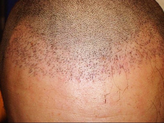 greffe cheveux raté