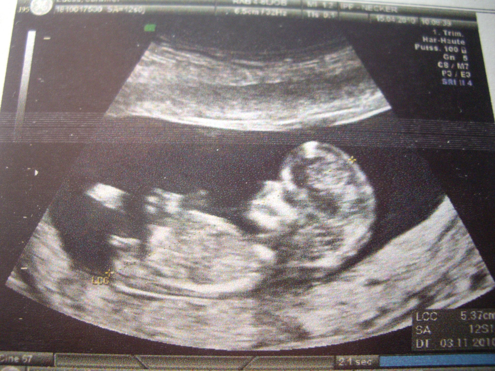 Echo 18 Sa Fille Ou Gars Echographie Connaitre Le Sexe De Votre Bebe Forum Grossesse Amp Bebe Doctissimo