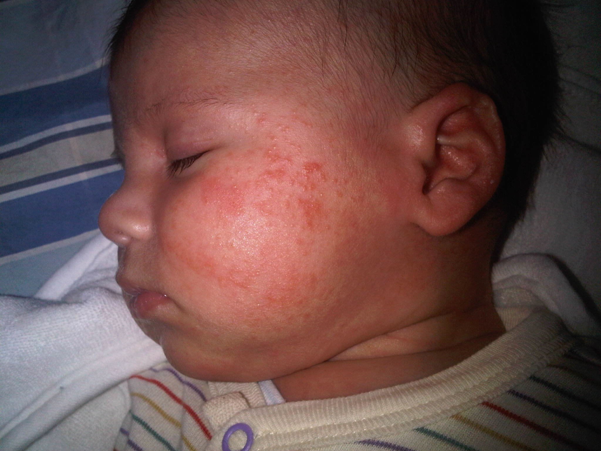 Petits Boutons Et Plaques Rouges Soins Quotidiens De Bebe Forum Grossesse Amp Bebe Doctissimo Petits Boutons Et Plaques Rouges Soins Quotidiens De Bebe Forum Grossesse Amp Bebe Doctissimo