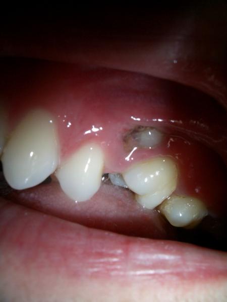 Tache Blanche Sur Gencive Problemes Dentaires Forum Sante Doctissimo