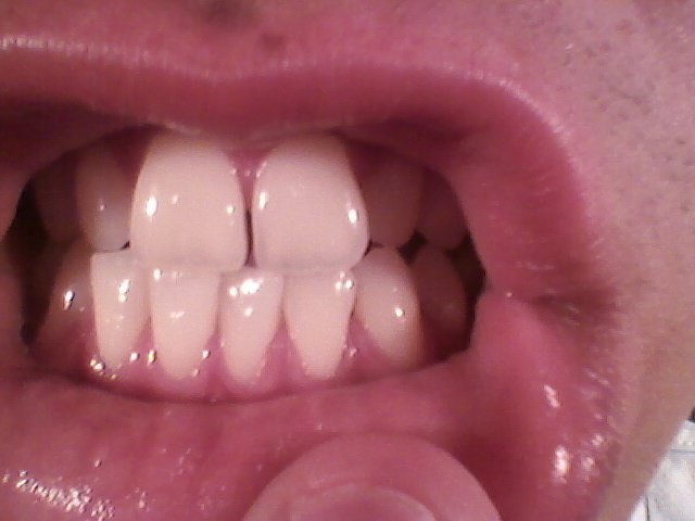 Dechaussement De Dents O Problemes Dentaires Forum Sante