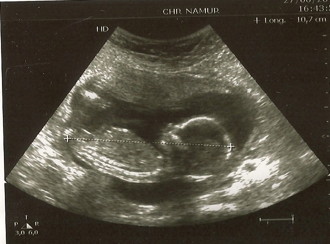 Avis 16 Sa 1 Echographie Connaitre Le Sexe De Votre Bebe Forum Grossesse Amp Bebe Doctissimo