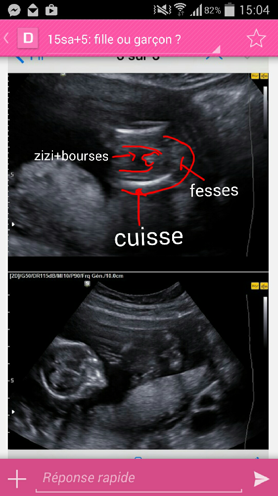Echographie Rose Et Bleu Paris Sema Echographie Rose Et Bleu Paris Sema