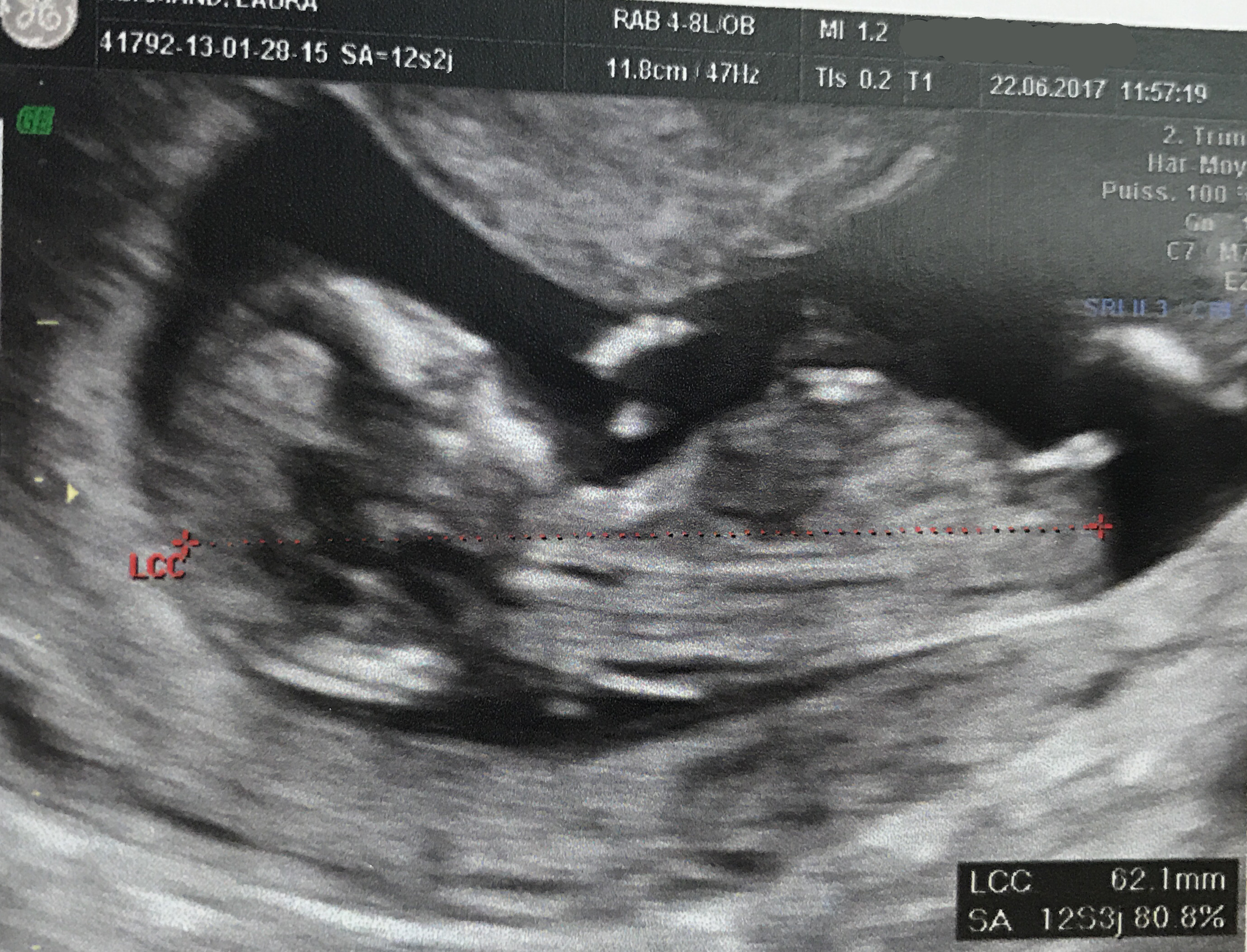 Avis Sexe Bebe Echo 12sa Echographie Connaitre Le Sexe De Votre Bebe Forum Grossesse Amp Bebe Doctissimo Avis Sexe Bebe Echo 12sa Echographie Connaitre Le Sexe De Votre Bebe Forum Grossesse Amp Bebe Doctissimo