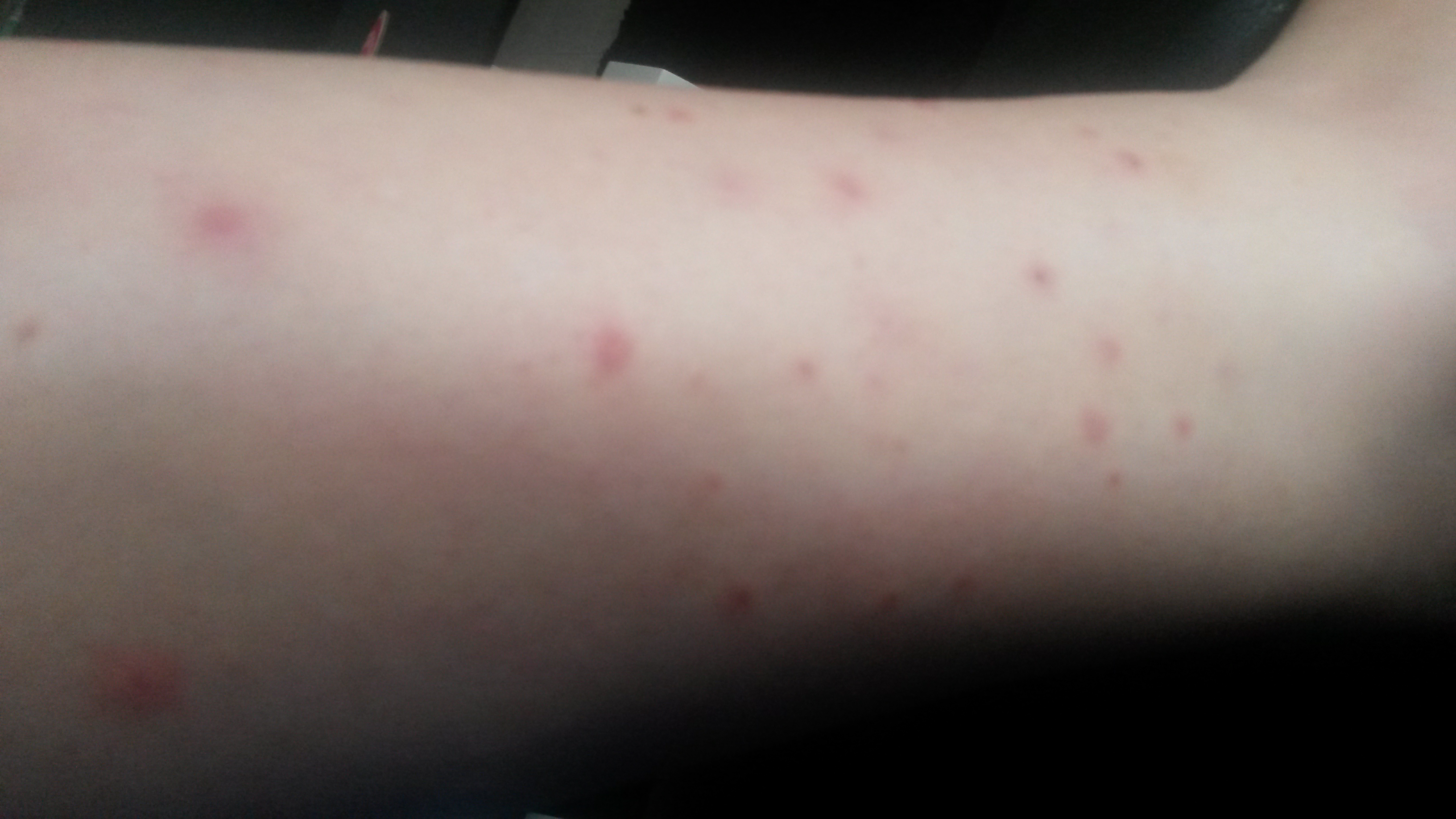 bouton après rasage jambe