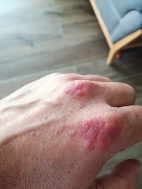 Boutons Rouges qui grattent sur la face dorsale de la main. Allergies