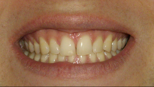 Boutons Blanc Sur Les Levres De La Bouche Acne Psoriasis Et Problemes De Peau Forum Sante Doctissimo Boutons Blanc Sur Les Levres De La Bouche Acne Psoriasis Et Problemes De Peau Forum Sante Doctissimo