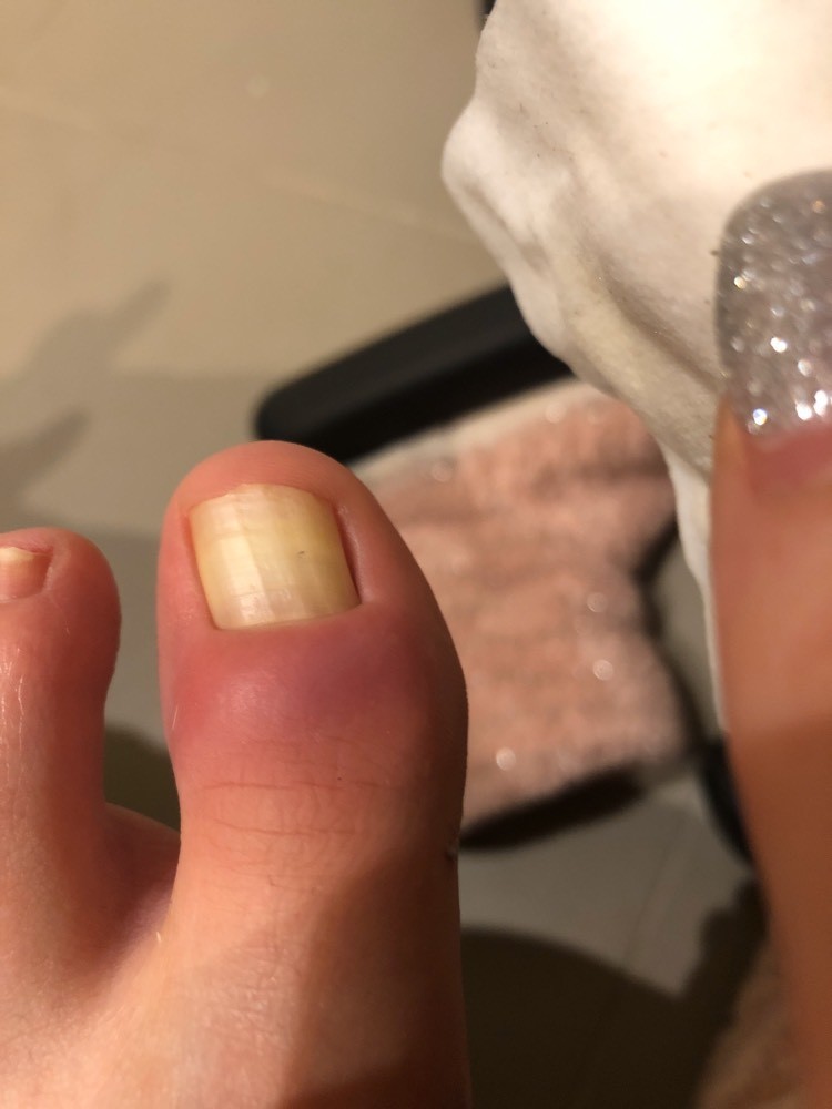 Mal Au Pouce D Orteil Douleur Forum Sante Doctissimo