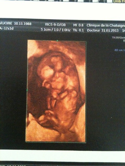 Girl Ou Boy Echo 3d 12sa Echographie Forum Grossesse Bebe