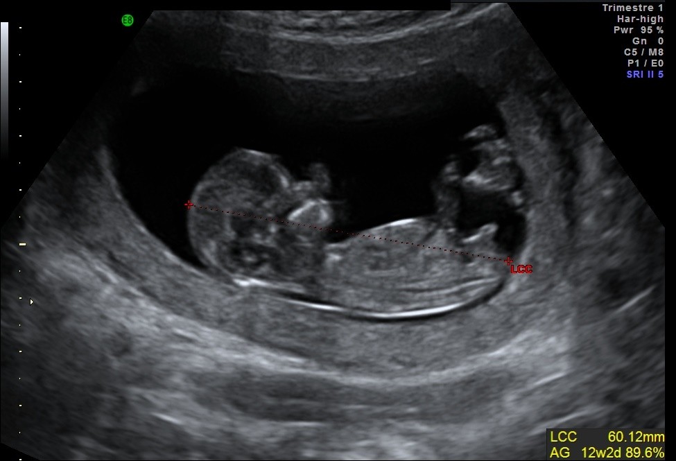 Echo Des 11 Sa 5 Echographie Connaitre Le Sexe De Votre Bebe Forum Grossesse Amp Bebe Doctissimo